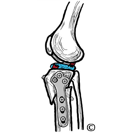 Image of a canine knee joint with a torn cranial cruciate ligament. - Image copyright of Rebecca Jones