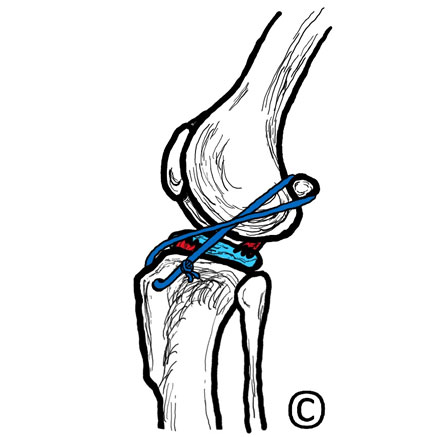 Image of a canine knee joint with a torn cranial cruciate ligament. - Image copyright of Rebecca Jones